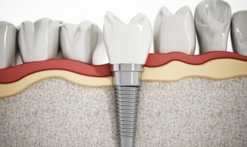Implanty stomatologiczne – piękny uśmiech na długie lata